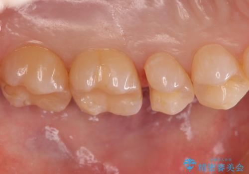 歯と歯の間の虫歯 セラミックインレーでの治療の治療中