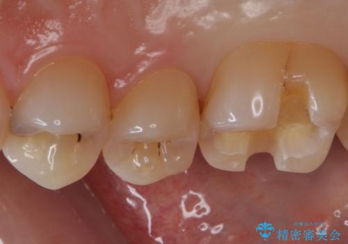 銀歯を白くしたい セラミックインレーでの治療の治療中