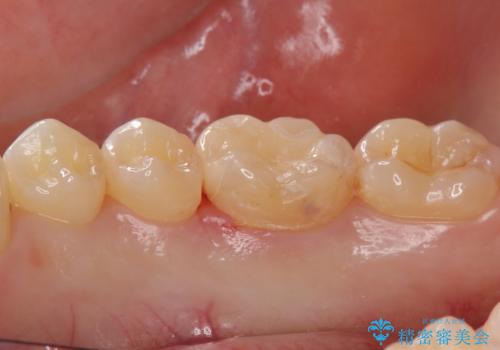 矯正後の虫歯治療 セラミックインレーでの治療の治療後