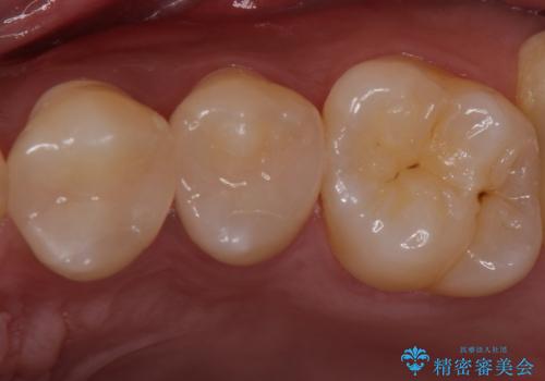 銀歯を目立たなくしたい セラミックインレーでの治療の治療後