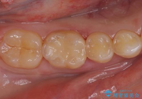 矯正後の虫歯治療 セラミックインレーでの治療の症例 治療後