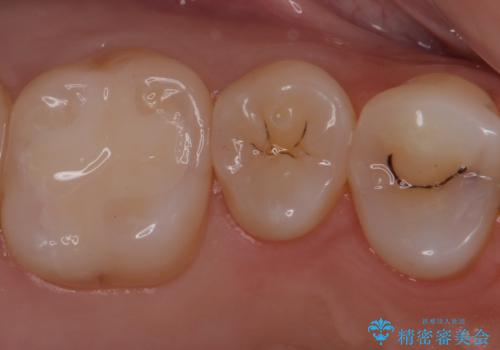 銀歯を白くしたい　セラミックインレーでの治療の症例 治療後