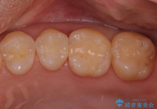 歯と歯の間の虫歯　セラミックインレーでの治療の症例 治療後