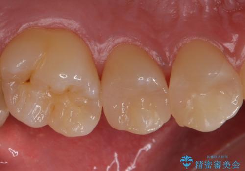 銀歯を目立たなくしたい セラミックインレーでの治療の治療後