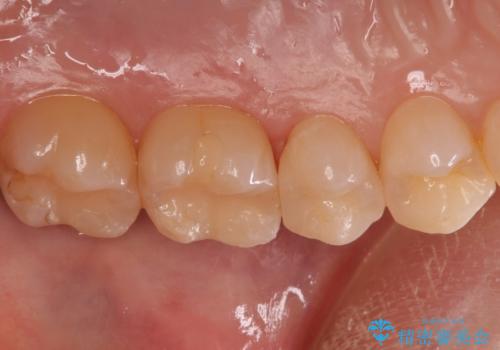 歯と歯の間の虫歯 セラミックインレーでの治療の治療後