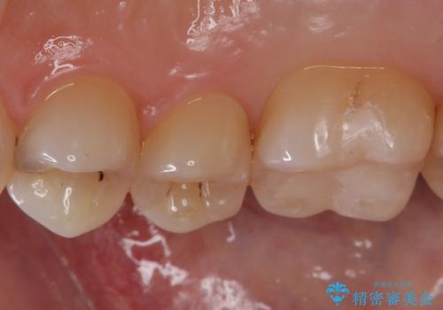 銀歯を白くしたい セラミックインレーでの治療の治療後