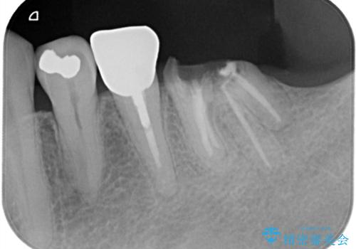 【インプラント】銀歯が取れて歯ごと折れたの治療前