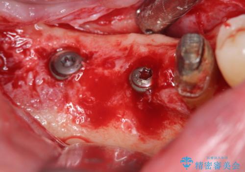 歯周病により抜去した歯のインプラント治療の治療中