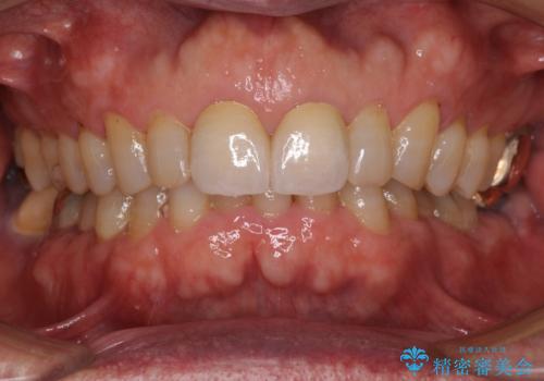 前歯の隙間をオールセラミッククラウンで自然にの治療後