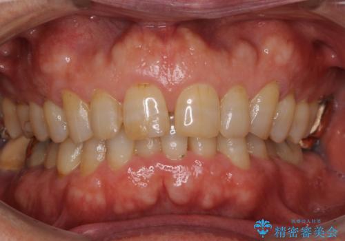 前歯の隙間をオールセラミッククラウンで自然にの治療前