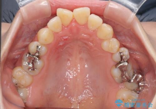 大きなむし歯の奥歯を抜歯してスペースを活用　ワイヤー装置による抜歯矯正の治療前