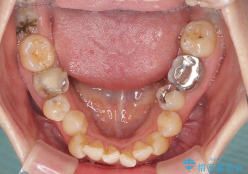 大きなむし歯の奥歯を抜歯してスペースを活用　ワイヤー装置による抜歯矯正の治療前