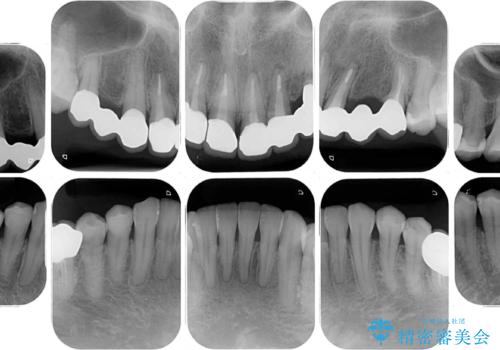 欠損やむし歯の歯をきれいなセラミックに 全顎虫歯治療の治療後