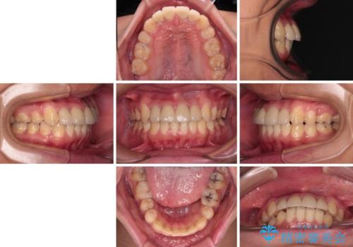 前歯のデコボコとむし歯だらけの歯列 矯正治療と虫歯治療の治療後