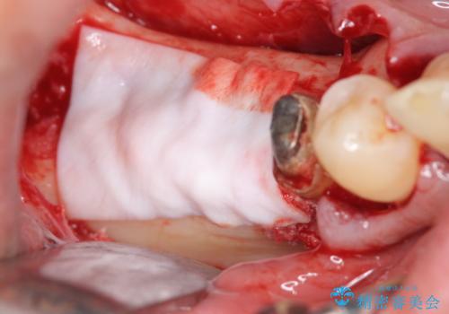歯周病により抜去した歯のインプラント治療の治療中
