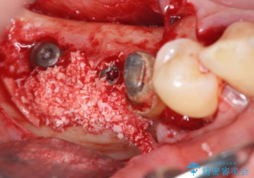 歯周病により抜去した歯のインプラント治療の治療中