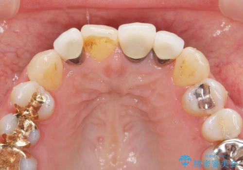 [ セラミック治療 ]  見た目の気になる前歯を綺麗にしたいの治療前
