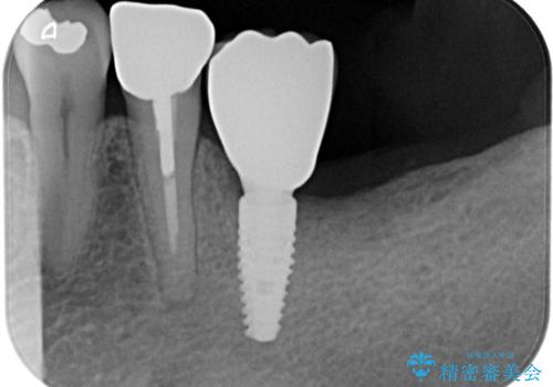 【インプラント】銀歯が取れて歯ごと折れたの治療後