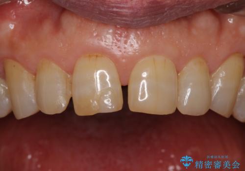 前歯の隙間をオールセラミッククラウンで自然にの治療前