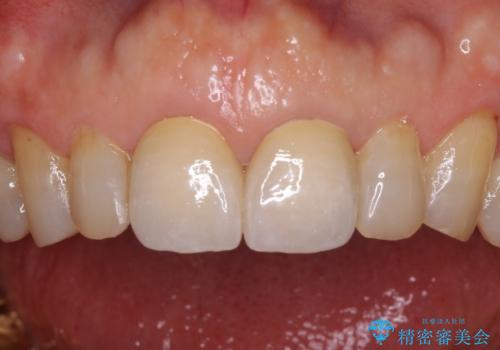 前歯の隙間をオールセラミッククラウンで自然にの治療後