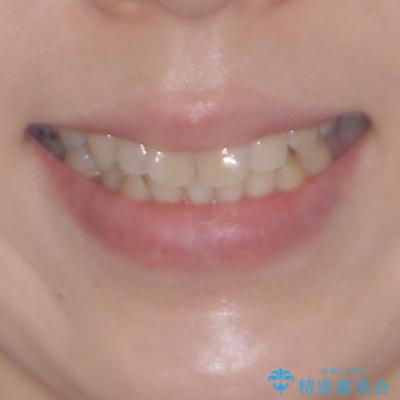 大きなむし歯の奥歯を抜歯してスペースを活用　ワイヤー装置による抜歯矯正の治療前（顔貌）