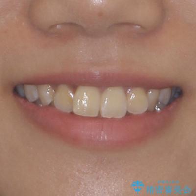 前歯のデコボコと隠れてしまう下顎前歯　インビザラインですっきりと改善の治療前（顔貌）
