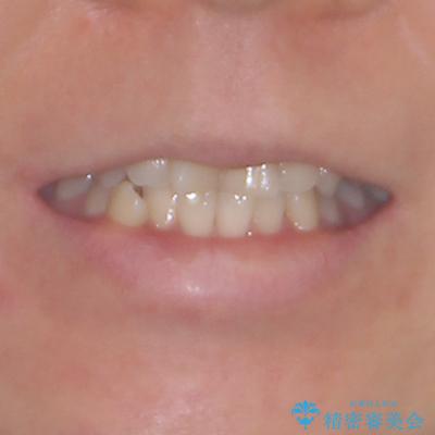 気になる歯列不正とむし歯を治療　インビザライン治療と虫歯治療の治療前（顔貌）
