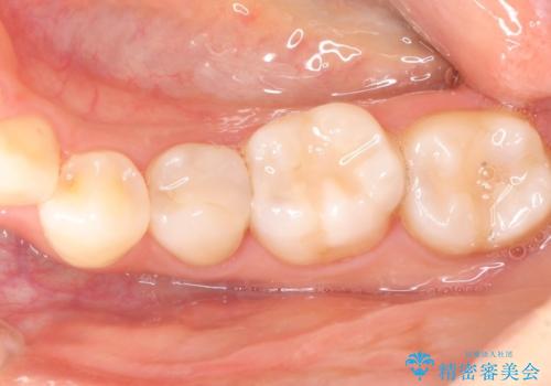 【オールセラミッククラウン】根管治療した歯の被せ物治療の症例 治療前