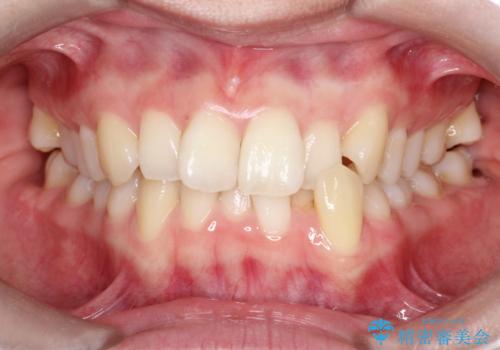 【インビザライン】 前歯の反対咬合を治したいの治療前