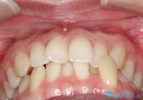 【インビザライン】 前歯の反対咬合を治したいの治療前