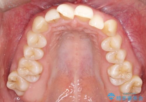 【インビザライン】 前歯の反対咬合を治したいの治療前
