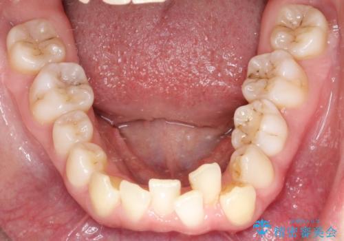 【インビザライン】 前歯の反対咬合を治したいの治療前