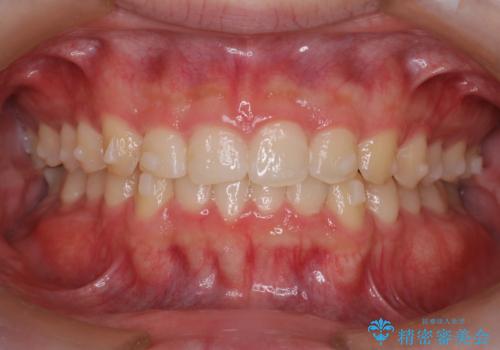 【インビザライン】前歯のガタガタと、前歯の噛み合わせが深いことを治したい。の治療中