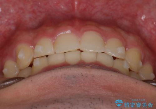 【インビザライン】前歯のガタガタと、前歯の噛み合わせが深いことを治したい。の治療中