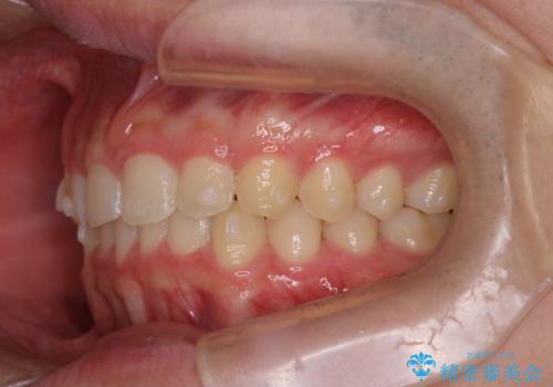【インビザライン】前歯のガタガタと、前歯の噛み合わせが深いことを治したい。の治療中