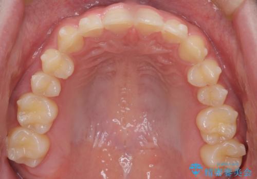 【インビザライン】前歯のガタガタと、前歯の噛み合わせが深いことを治したい。の治療中