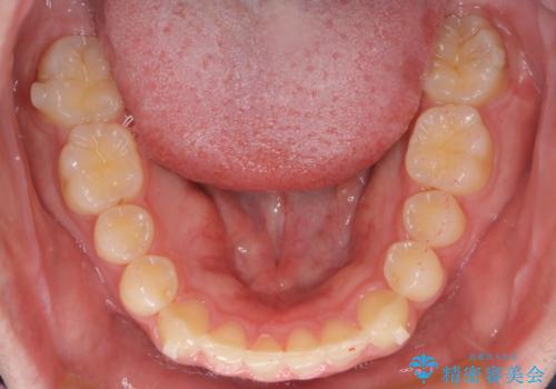 【インビザライン】前歯のガタガタと、前歯の噛み合わせが深いことを治したい。の治療中