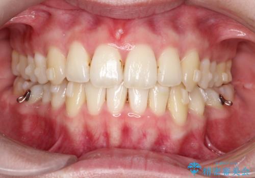 【インビザライン】 前歯の反対咬合を治したいの治療中