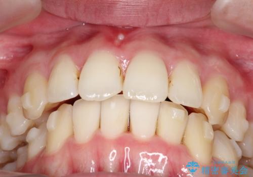 【インビザライン】 前歯の反対咬合を治したいの治療中