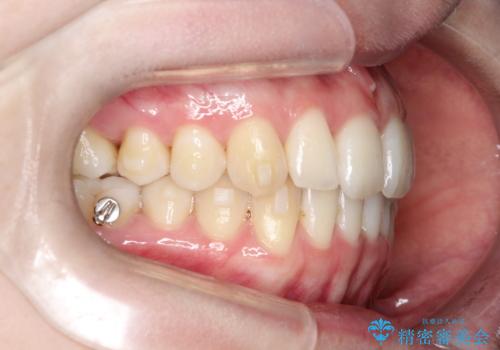 【インビザライン】 前歯の反対咬合を治したいの治療中