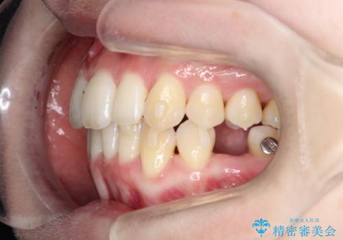 【インビザライン】 前歯の反対咬合を治したいの治療中
