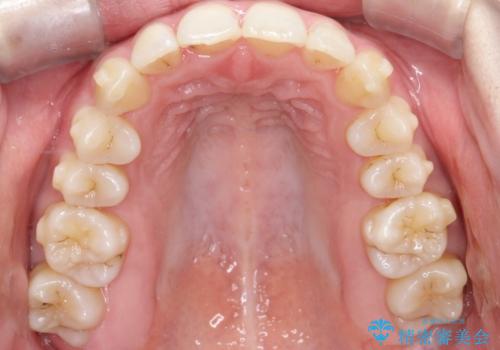 【インビザライン】 前歯の反対咬合を治したいの治療中