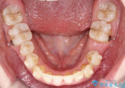 【インビザライン】 前歯の反対咬合を治したいの治療中