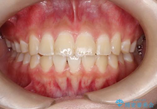 【インビザライン】前歯を下げたいの治療中