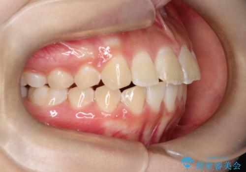 【インビザライン】前歯を下げたいの治療中