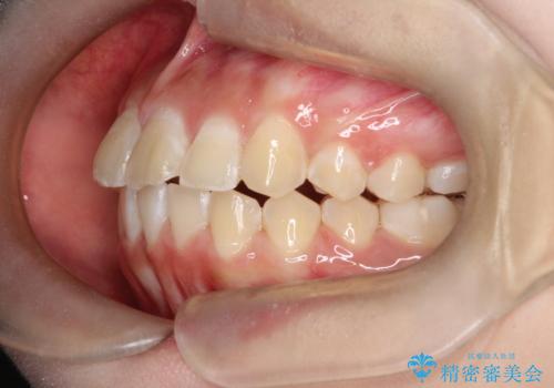 【インビザライン】前歯を下げたいの治療中