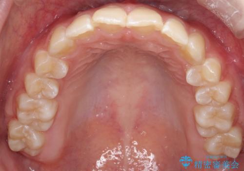 【インビザライン】前歯を下げたいの治療中