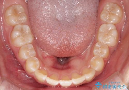 【インビザライン】前歯を下げたいの治療中