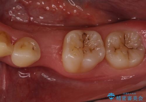 小臼歯のインプラントの治療前