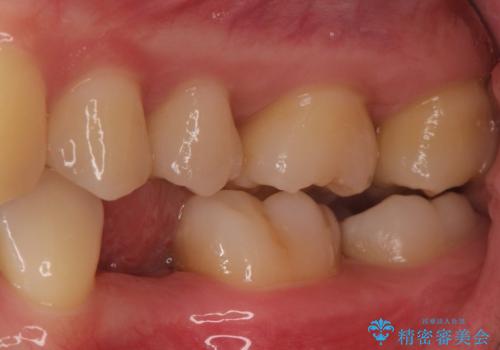 小臼歯のインプラントの治療前